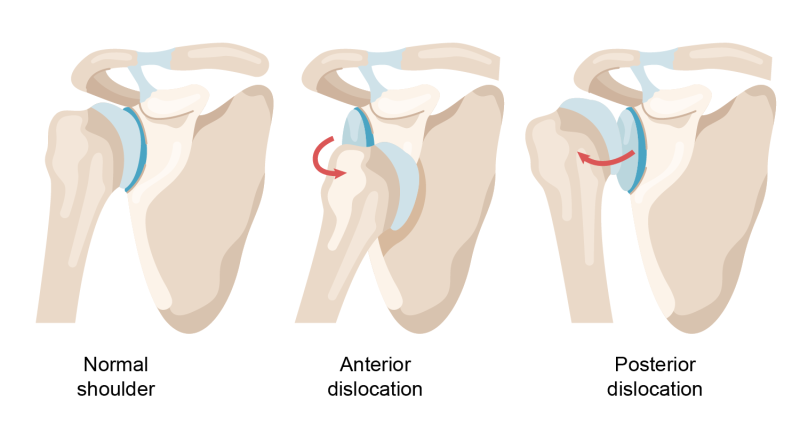Anatomic illustration of the shoulder joint showing forward (anterior) dislocation and backward (posterior) dislocation. Anatomic illustration of the shoulder joint showing forward (anterior) dislocation and backward (posterior) dislocation.